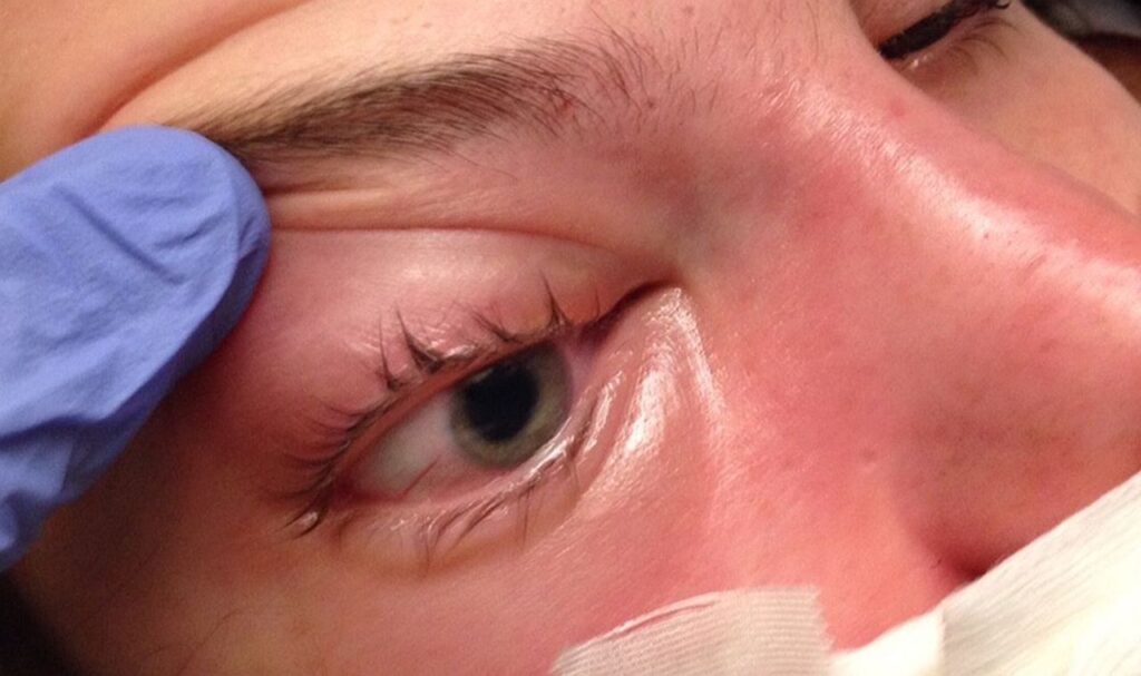 Mucormycosis